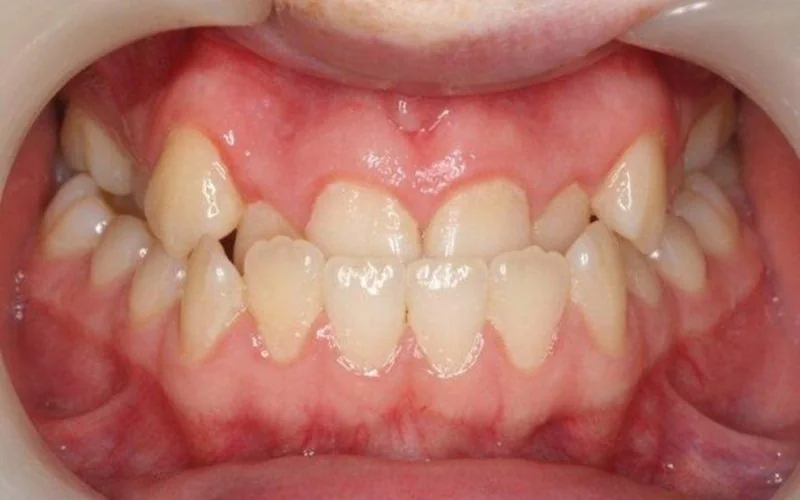 Ảnh chụp trong miệng: răng cửa hàm dưới nằm phía trước răng cửa hàm trên