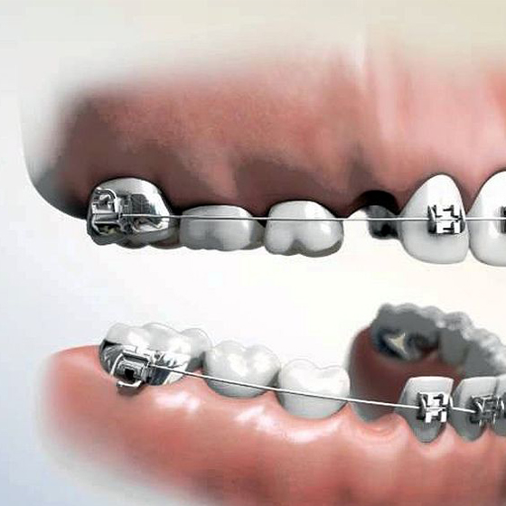 Mắc cài phân đoạn