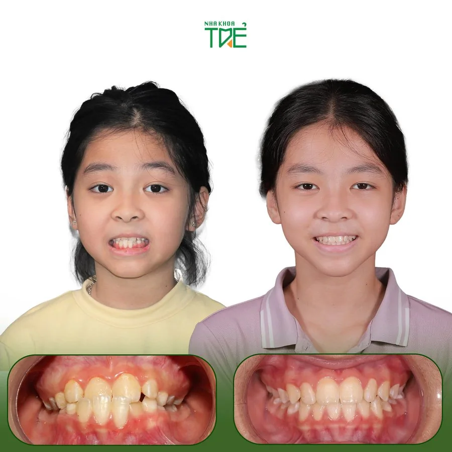 Ca chỉnh nha 1 tại Nha Khoa Trẻ: ảnh khuôn mặt và răng của bé trước (bên trái) và sau (bên phải) điều trị