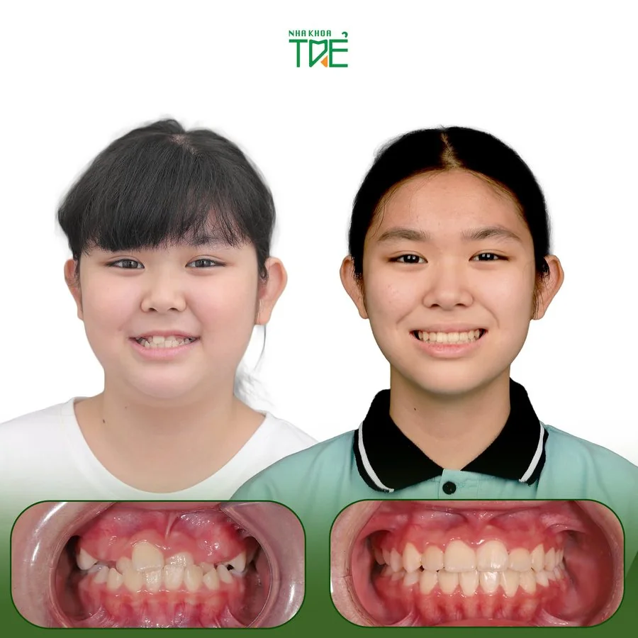Ca chỉnh nha 2 tại Nha Khoa Trẻ: ảnh khuôn mặt và răng của bé trước (bên trái) và sau (bên phải) điều trị
