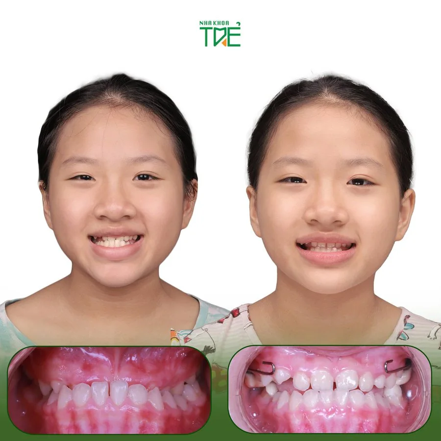 Ca chỉnh nha 3 tại Nha Khoa Trẻ: ảnh khuôn mặt và răng của bé trước (bên trái) và sau (bên phải) điều trị