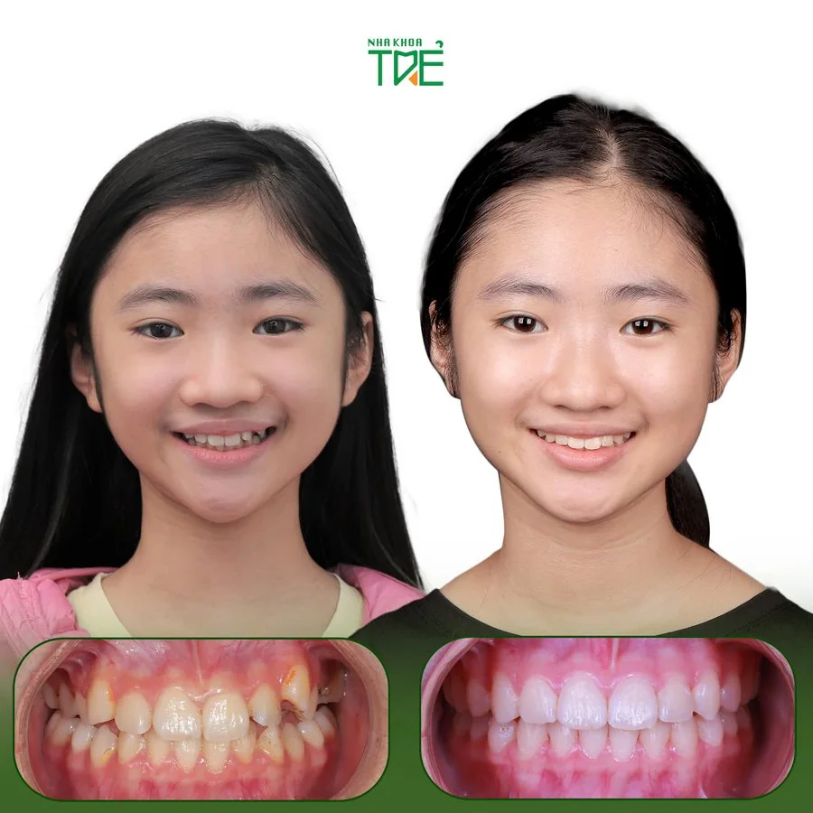 Ca chỉnh nha 4 tại Nha Khoa Trẻ: ảnh khuôn mặt và răng của bé trước (bên trái) và sau (bên phải) điều trị