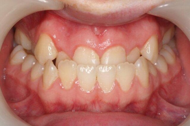 Răng mọc lộn xộn