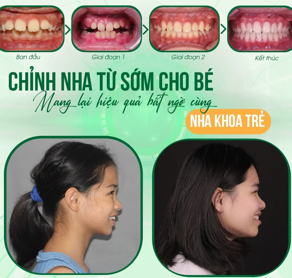 Một ca chỉnh nha sớm tại Nha Khoa Trẻ: ảnh răng ban đầu, giai đoạn 1, giai đoạn 2 và khi kết thúc, kèm ảnh nghiêng khuôn mặt trước và sau điều trị