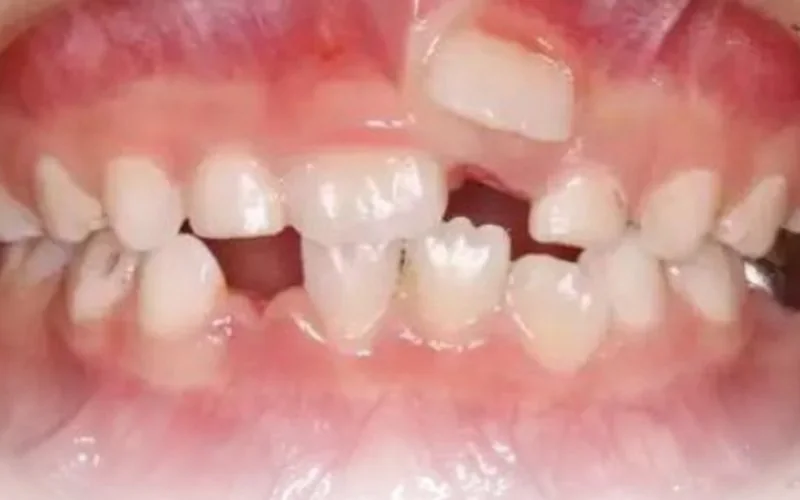 Răng của bé có nhiều kẽ hở giữa các răng
