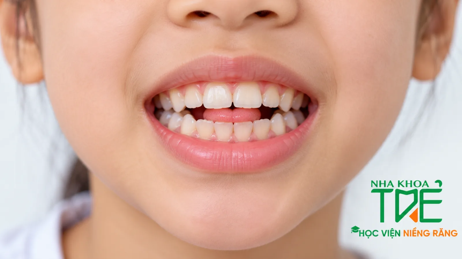 Cắn hở răng cửa, đầu lưỡi nằm giữa khe hở do thói quen đẩy lưỡi ở trẻ