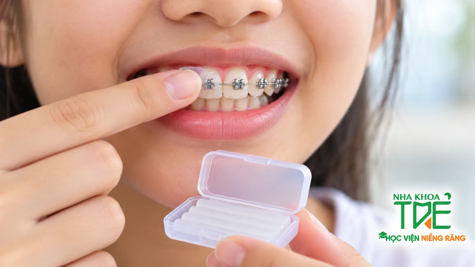 Dùng sáp nha khoa bọc mắc cài để giảm cộm má khi trẻ niềng răng