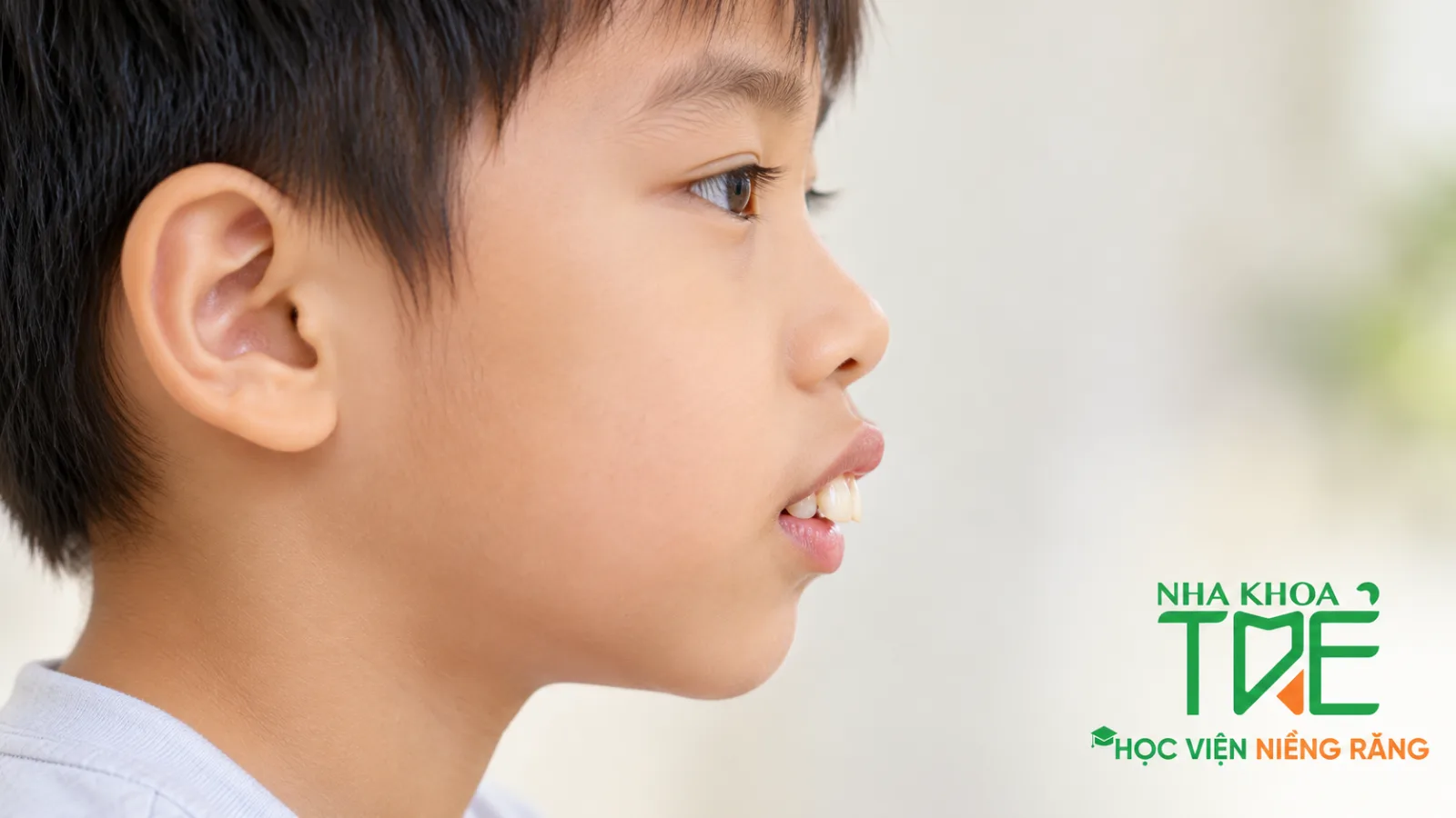 Răng hô ở trẻ nhìn nghiêng: răng cửa trên chìa ra trước, môi dưới nằm sau răng