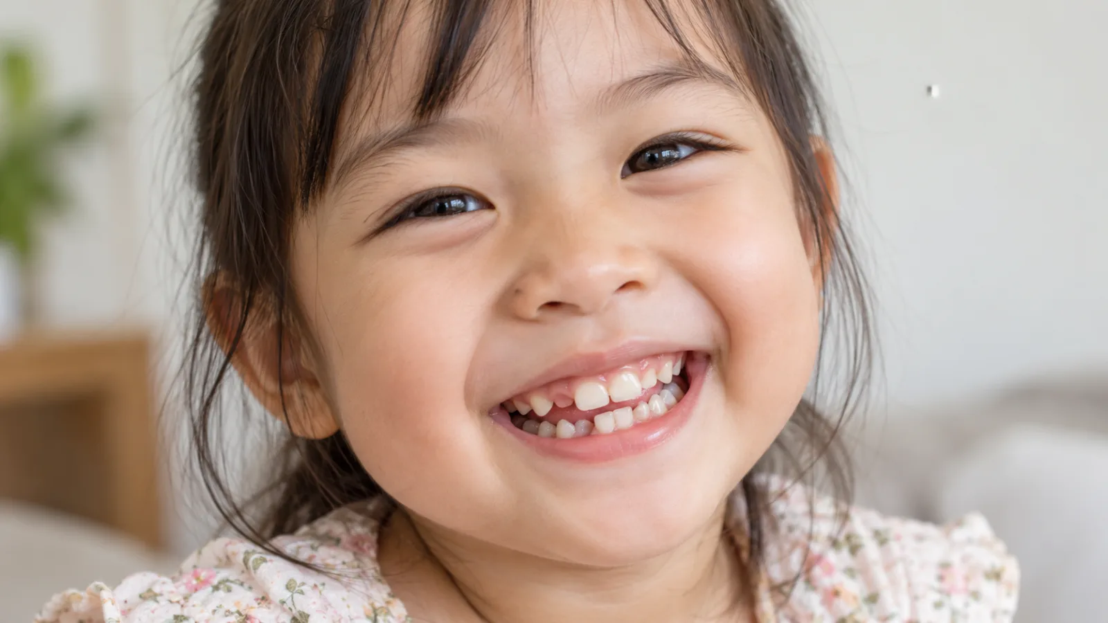 Bé 4 tuổi có răng sữa mọc lệch, vài răng cửa xoay và chồng nhẹ lên nhau