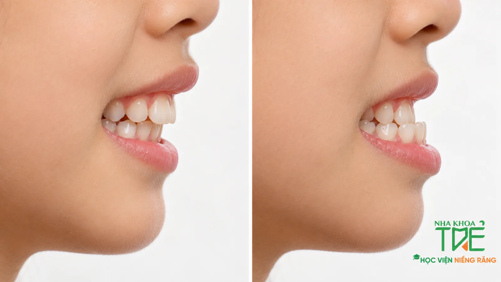 So sánh khớp cắn bình thường và răng móm ở trẻ, răng cửa dưới nằm trước