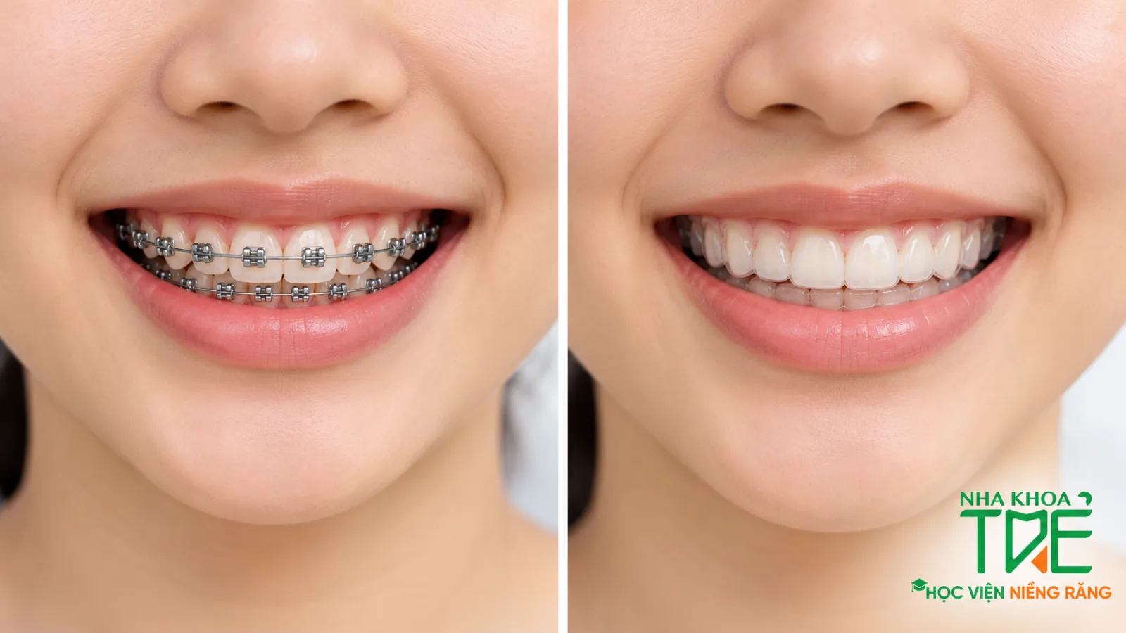 So sánh niềng răng mắc cài kim loại và khay trong suốt cho trẻ