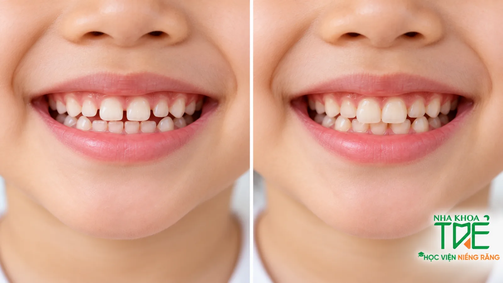 So sánh răng sữa có khe thưa bình thường và răng sữa mọc lệch, chen chúc