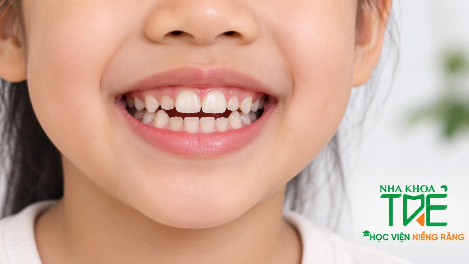 Trẻ mút tay kéo dài có thể gây cắn hở, răng cửa trên và dưới không chạm nhau